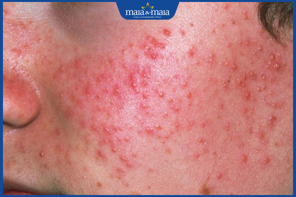 tình trạng đẩy mụn