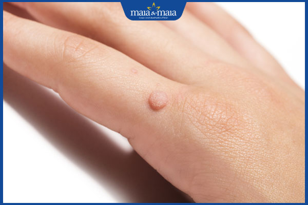 tình trạng mun ké ở tay