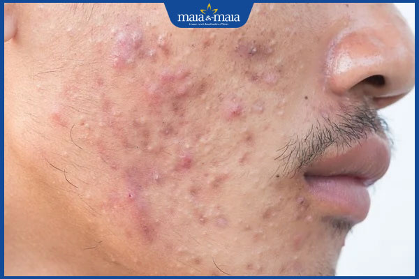 Bỏ túi quy trình chăm sóc da mụn tại nhà với 7 bước đơn giản 8 tình trạng mụn nặng