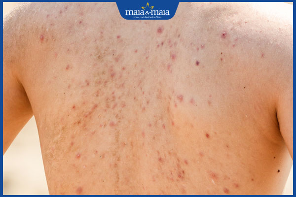 tình trạng nóng trong người nổi mụn