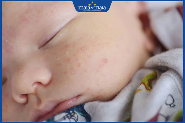 Mụn kê ở trẻ sơ sinh là như thế nào? Cách điều trị hiệu quả 3 trẻ bị mụn kê