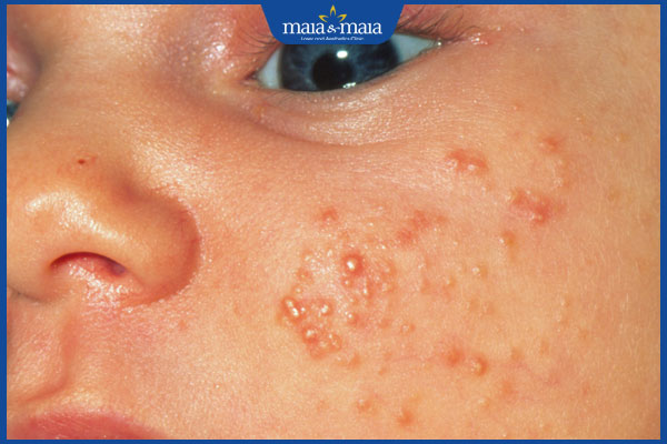 Mụn kê ở trẻ sơ sinh là như thế nào? Cách điều trị hiệu quả 2 trẻ sơ sinh bị mụn hạt kê