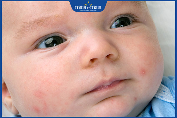 trẻ sơ sinh nổi mụn