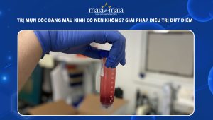 trị mụn cóc bằng máu kinh