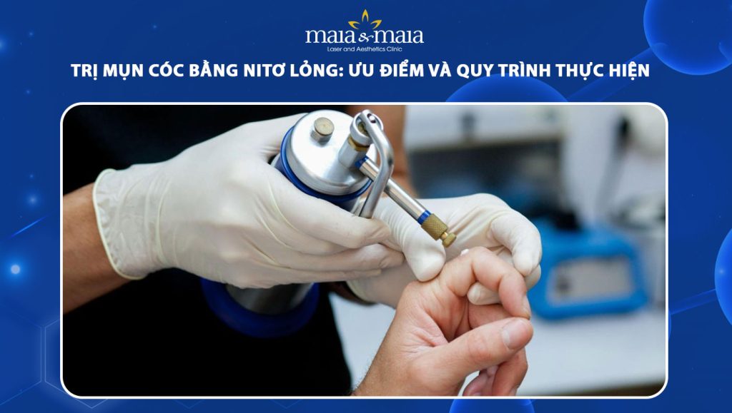 Trị mụn cóc bằng nitơ lỏng: Ưu điểm và quy trình thực hiện 1 trị mụn cóc bằng nitơ lỏng