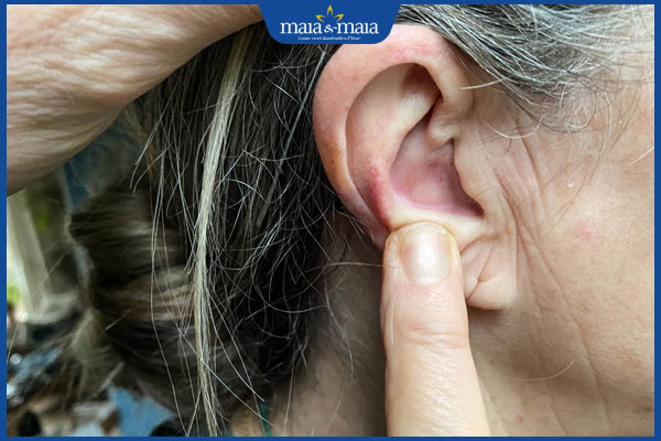 Cách chữa mụn trong tai hiệu quả dứt điểm và an toàn nhất 2 trị mụn trong tai