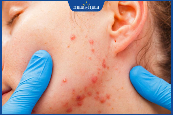 Mụn không nhân: Nhận biết, nguyên nhân và cách điều trị 3 viêm nhiễm do nặn mụn