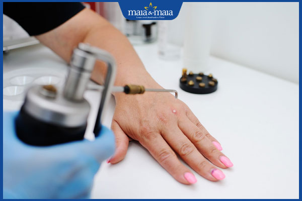 Trị mụn cóc bằng nitơ lỏng: Ưu điểm và quy trình thực hiện 3 xịt nitơ lỏng trị mụn cóc