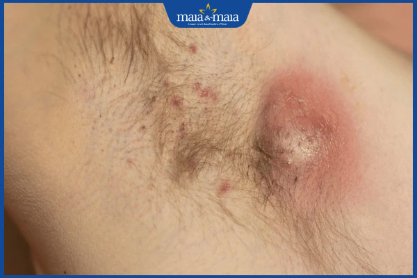 Mụn ở nách nặn ra có mùi hôi do đâu? Xử lý như thế nào? 3 xuất hiện mụn ở nách