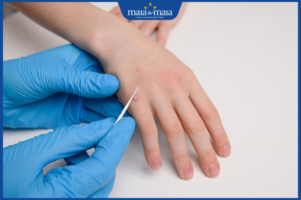 bác sĩ kiểm tra mụn cóc ở tay