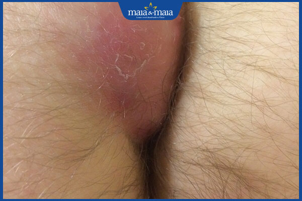 Mụn ở hậu môn nguy hiểm không? Nguyên nhân & cách phòng ngừa 3 bệnh xoang lông