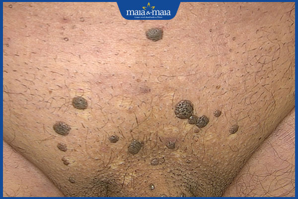 Mụn cóc sinh dục có nguy hiểm không? Cách xử lý tốt nhất 3 biến chứng mụn cóc sinh dục