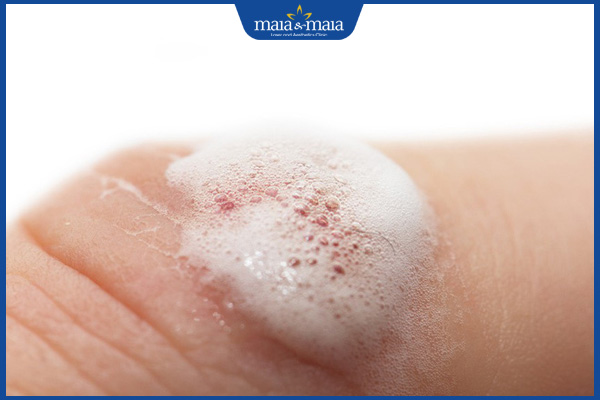 bôi oxy già lên nốt mụn