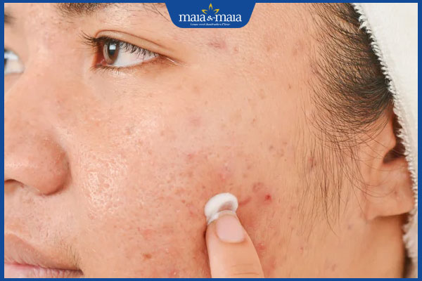 Da mặt sần sùi nhiều mụn do đâu? Cách xử lý dứt điểm 3 bôi thuốc gom cồi mụn