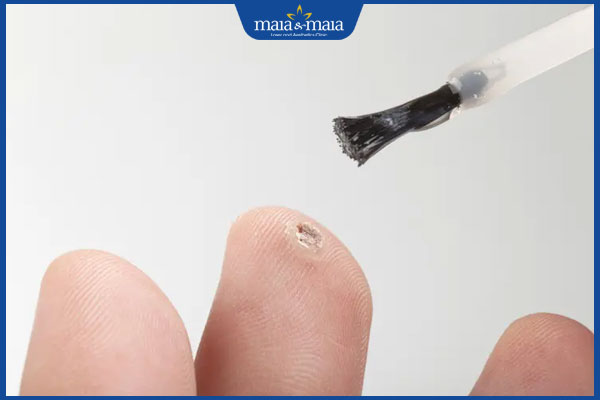 Tổng hợp 6 loại thuốc trị mụn cóc phổ biến và lưu ý khi dùng 2 bôi thuốc trị mụn cóc