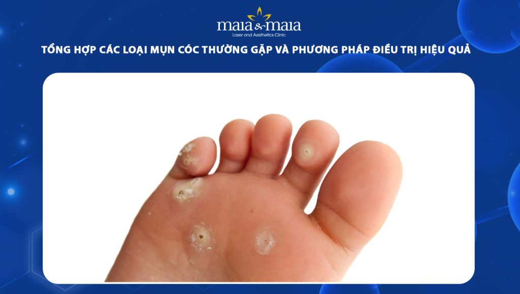 Các loại mụn cóc thường gặp và cách điều trị hiệu quả 1 các loại mụn cóc