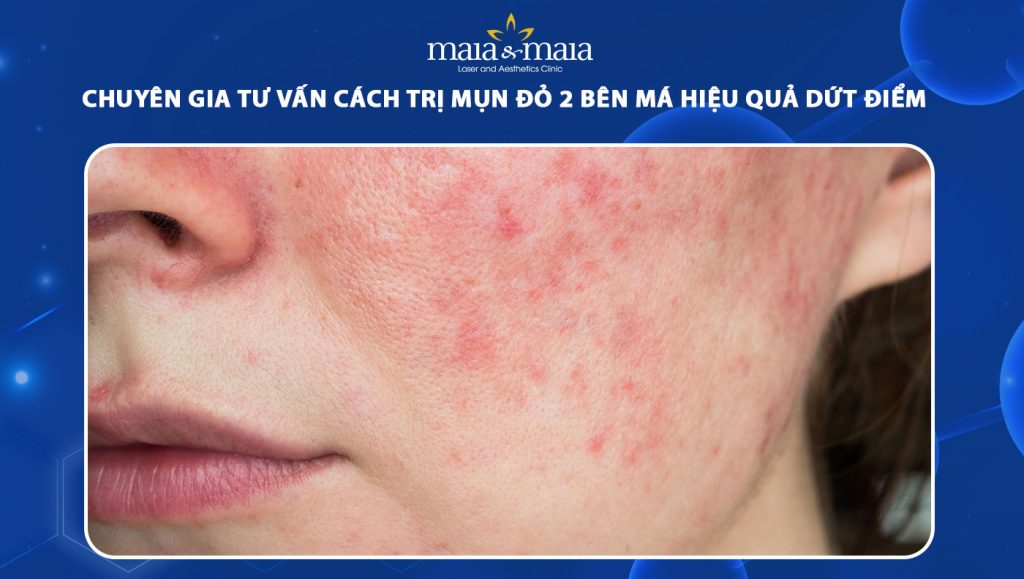 cách trị mụn đỏ 2 bên má