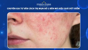 cách trị mụn đỏ 2 bên má
