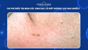 chi phí điều trị mụn cóc sinh dục