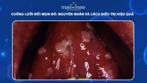 cuống lưỡi nổi mụn đỏ