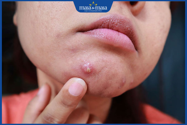 đặc điểm cồi mụn