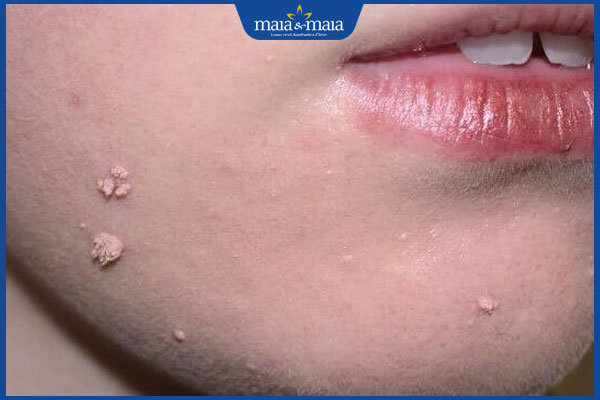 đặc điểm mụn cóc dạng sợi