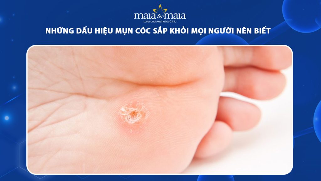 dấu hiệu mụn cóc sắp khỏi