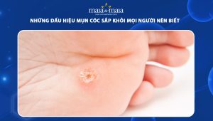 dấu hiệu mụn cóc sắp khỏi