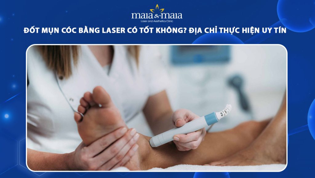 Đốt mụn cóc bằng laser tốt không? Địa chỉ thực hiện uy tín 1 đốt mụn cóc bằng laser