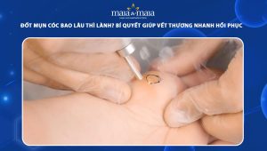đốt mụn cóc bao lâu thì lành