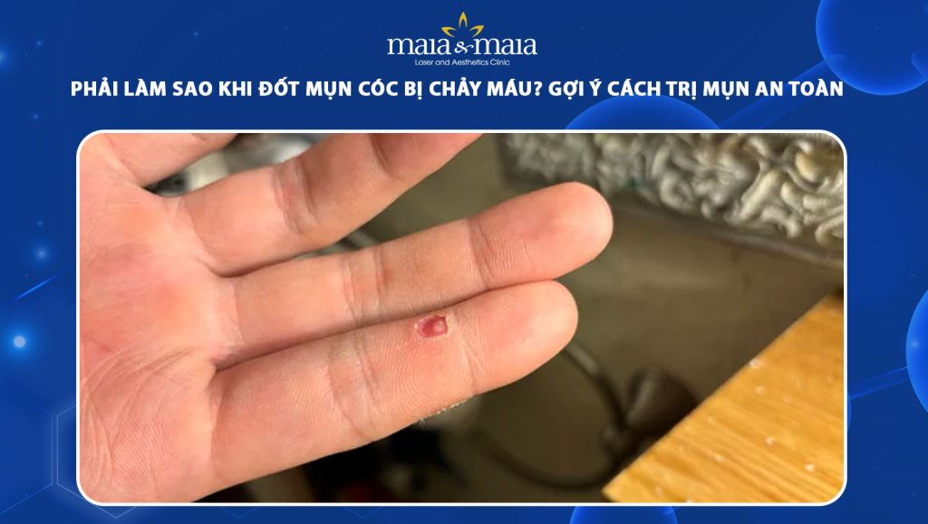 Đốt mụn cóc bị chảy máu phải làm sao? Cách để phòng ngừa 1 đốt mụn cóc bị chảy máu
