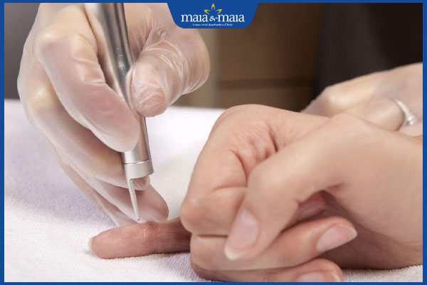 đốt mụn cóc ở tay