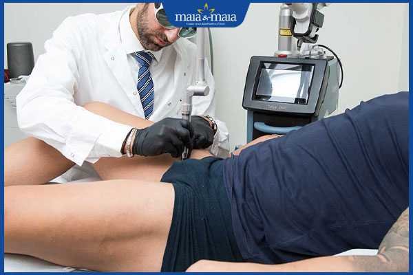 Mụn cóc sinh dục nam giới do đâu? Cách điều trị và ngăn ngừa 4 laser trị mụn cóc sinh dục