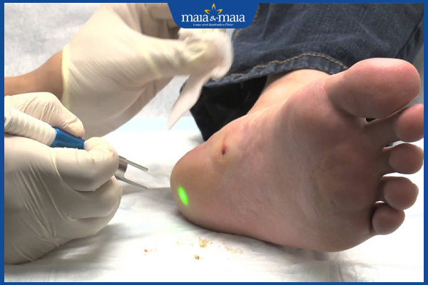 laser trị mụn cóc