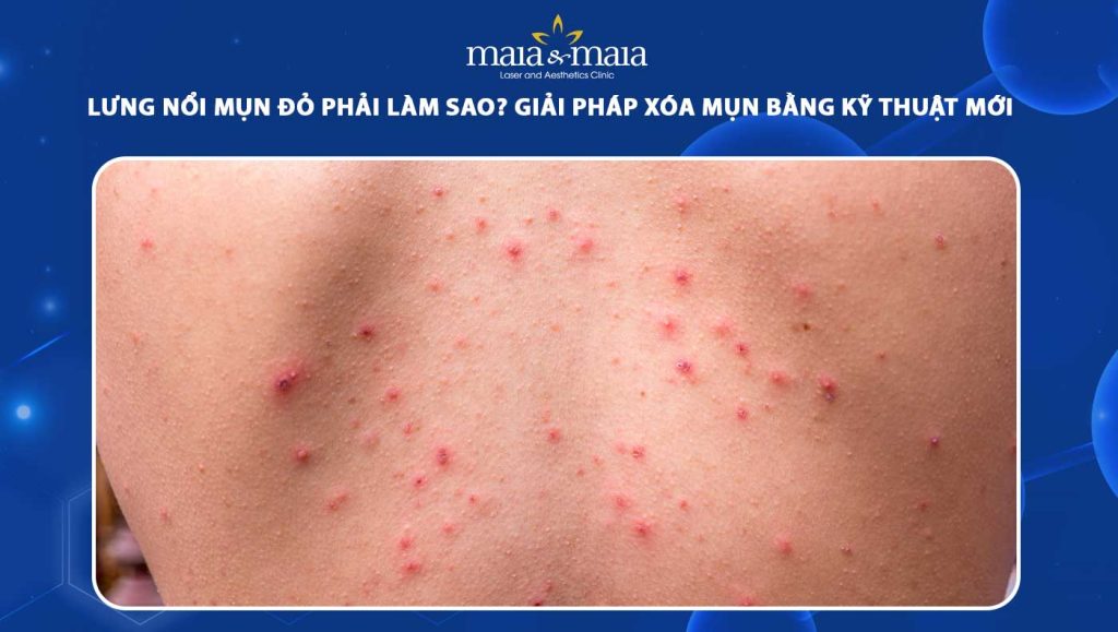 lưng nổi mụn đỏ