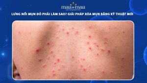 lưng nổi mụn đỏ