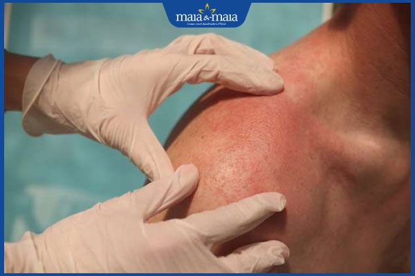 lưng nổi mụn đỏ thăm khám bác sĩ