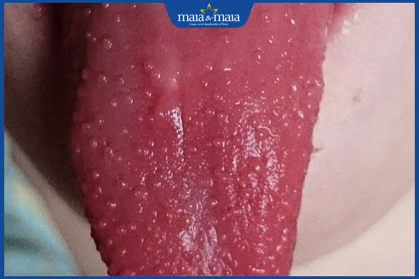 Cuống lưỡi nổi mụn đỏ: Nguyên nhân và cách điều trị hiệu quả 3 lưỡi nổi mụn li ti