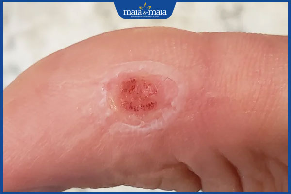 lưu ý khi trị mụn cóc bằng cây xương cá