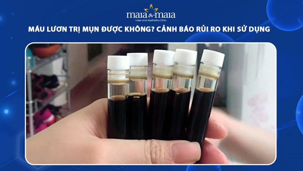 Máu lươn trị mụn được không? Cảnh báo rủi ro khi sử dụng 1 máu lươn trị mụn