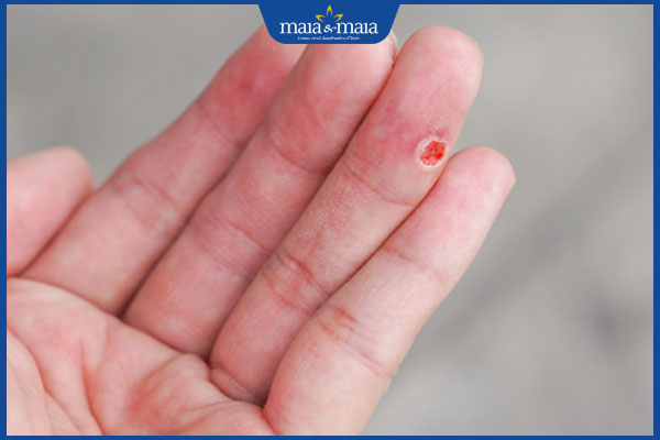 mụn cóc bị chảy máu