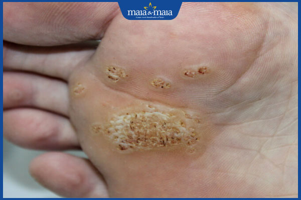 mụn cóc bị lây