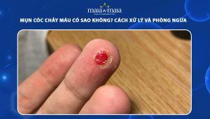 mụn cóc chảy máu