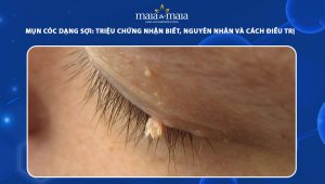 mụn cóc dạng sợi
