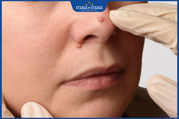 mụn cóc nổi trên mặt