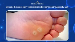 mụn cóc ở chân