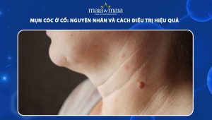 mụn cóc ở cổ