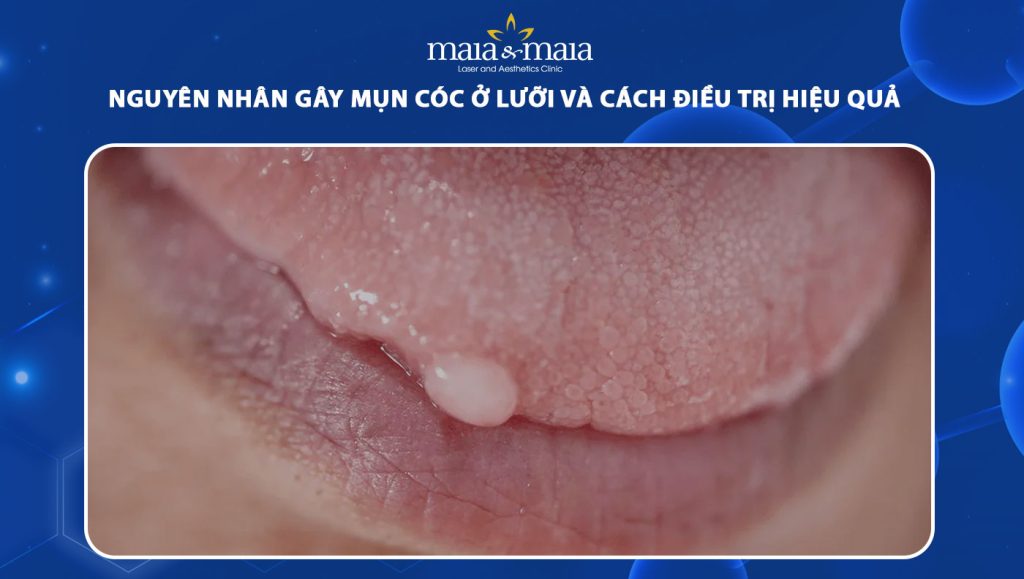 mụn cóc ở lưỡi