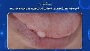 mụn cóc ở lưỡi