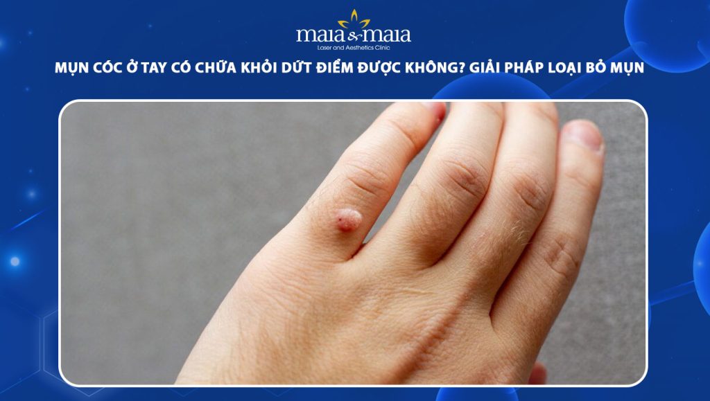 mụn cóc ở tay